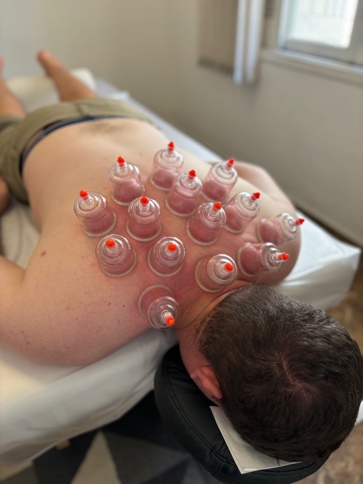 Read more about the article Benefícios da Ventosaterapia para Dores Musculares